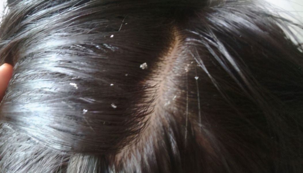 从头皮上抠出的白色小颗粒，是粉刺还是污垢？这4种原因要重视