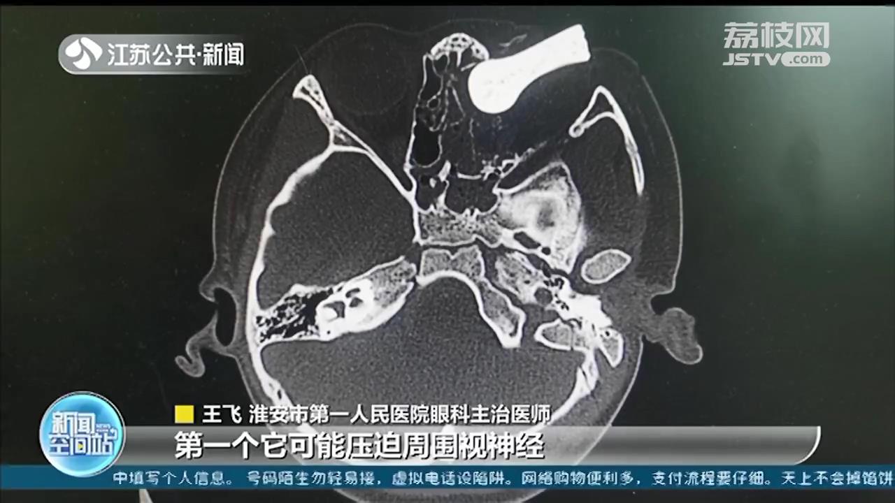 揪心！六岁男童遭遇交通意外，刹车把戳入眼眶 及时手术保住了眼睛