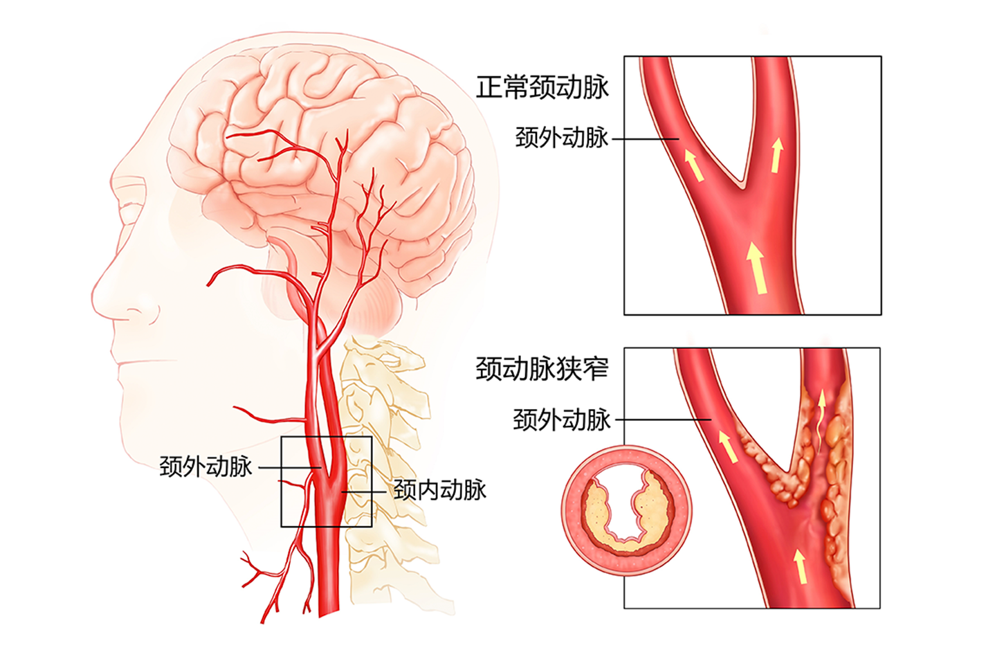 颈动脉狭窄=易堵塞=易脑血梗？它的危害你知道吗？