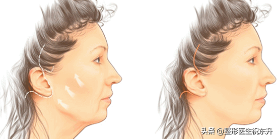 面部轮廓开始（已经）走样，可以考虑拉皮手术，纠正"垂、松、垮"