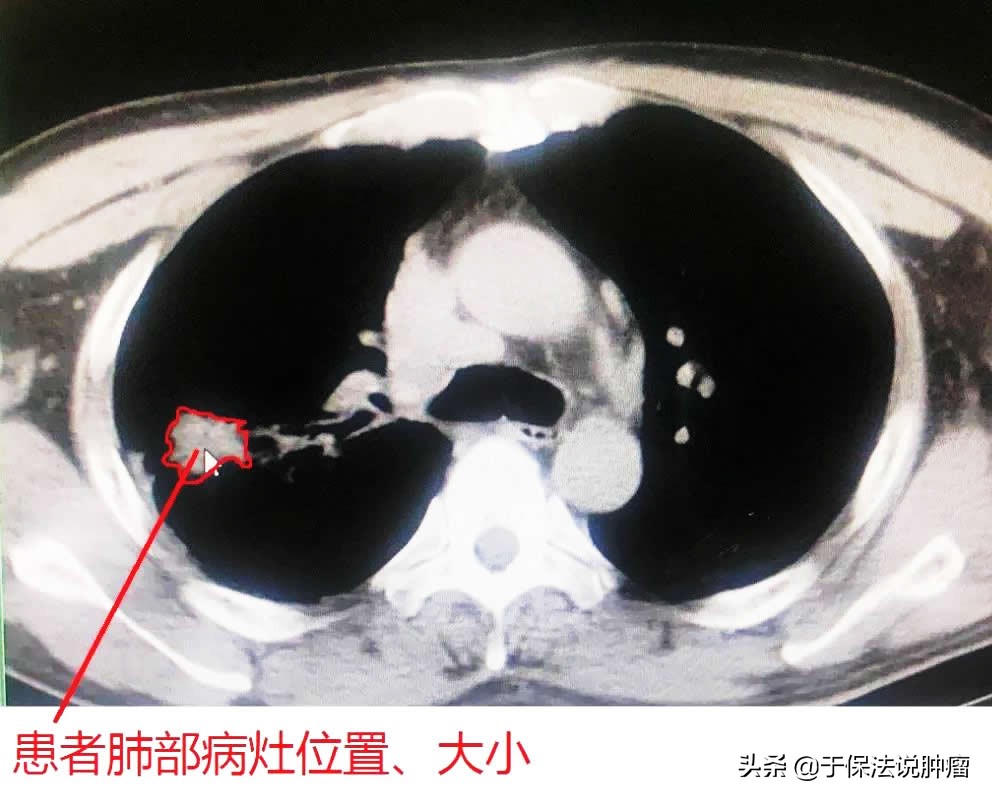 肺癌(非小细胞)拒绝化疗，接受缓释库治疗后，实现五年生存