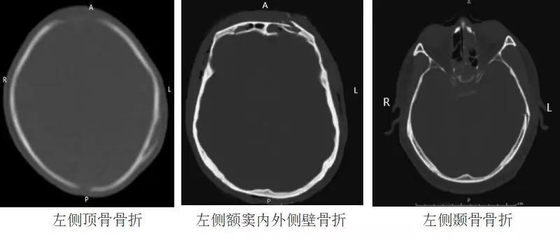 认识这几种头颅 CT，值夜班稳了