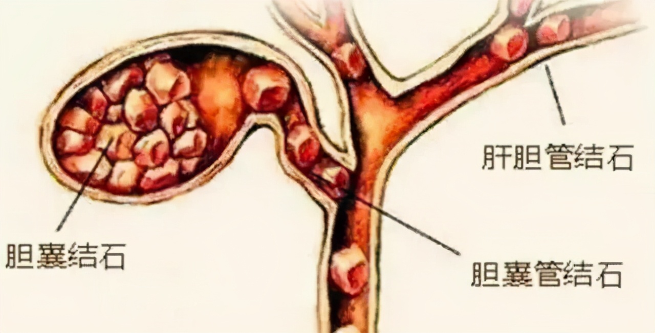 经常背痛？你可能得了胆囊炎