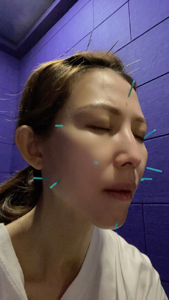 張晉蔡少芬臘八節做針灸，娘娘為保凍顏滿臉扎針，三個兒女齊出鏡