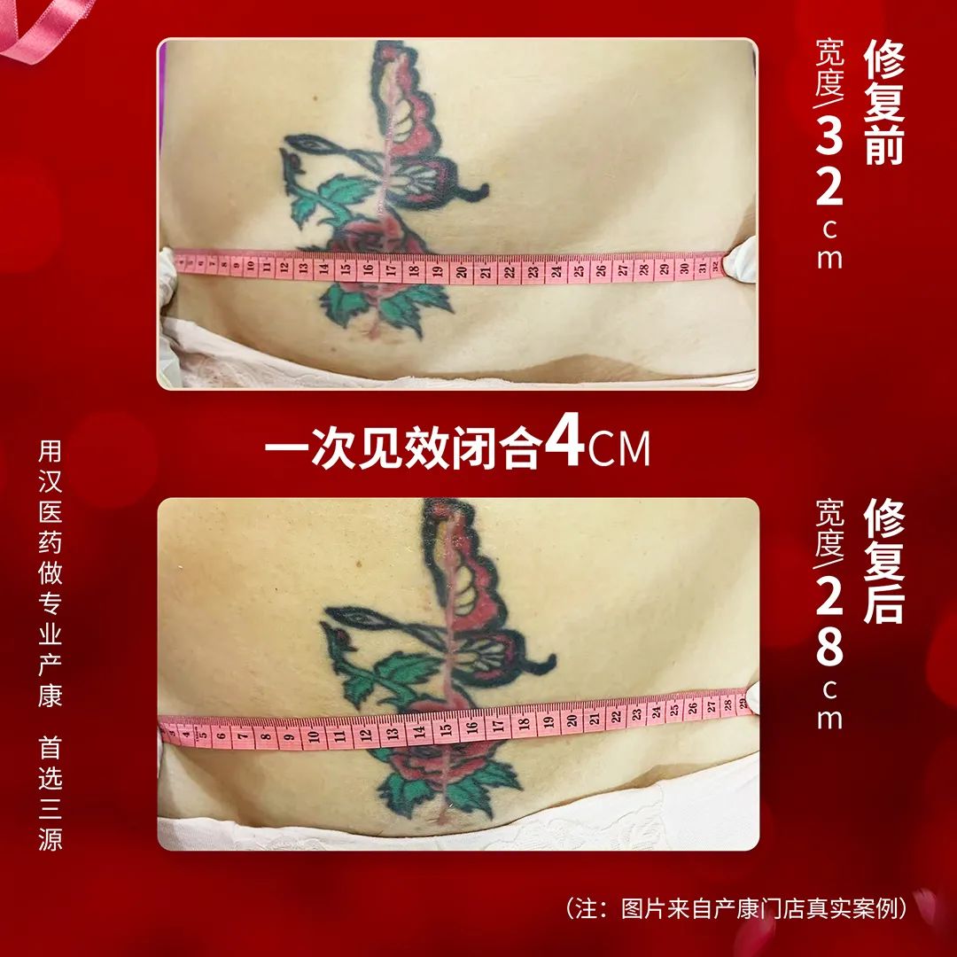 骨盆修復(fù) | 打響骨盆保衛(wèi)戰(zhàn)！重塑女人青春源