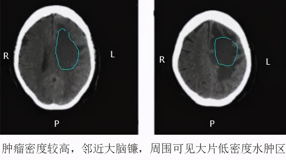 认识这几种头颅 CT，值夜班稳了