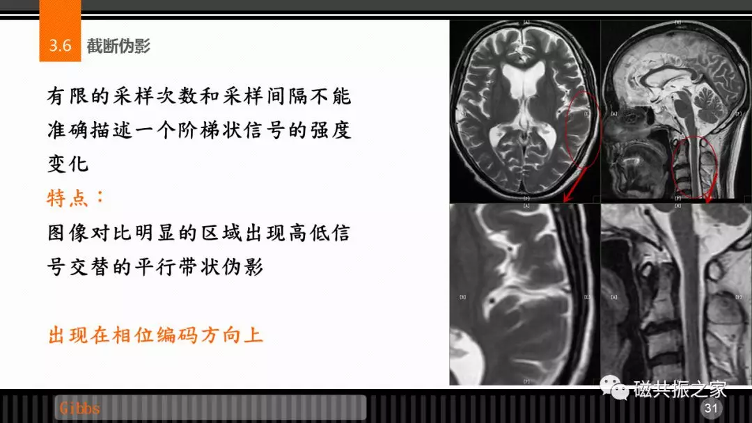 磁共振常见伪影及策略