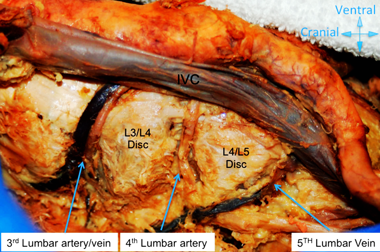 文献查阅 | LLIF-微创外侧腰椎椎体入路的外科血管解剖