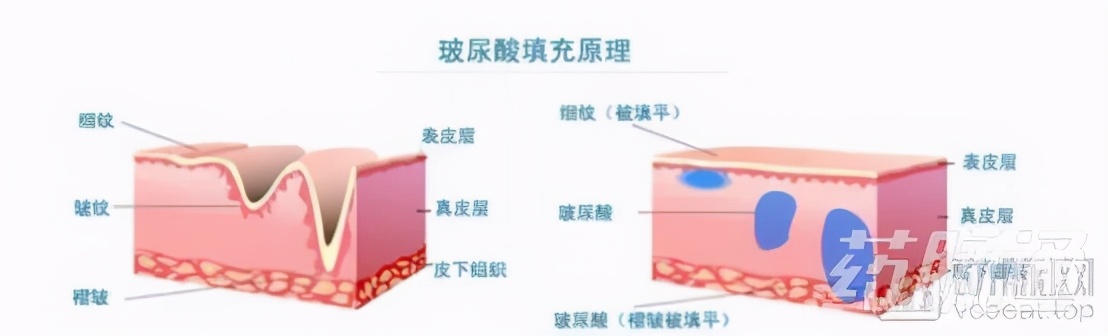 玻尿酸，医药行业中的茅台！市场已经达百亿