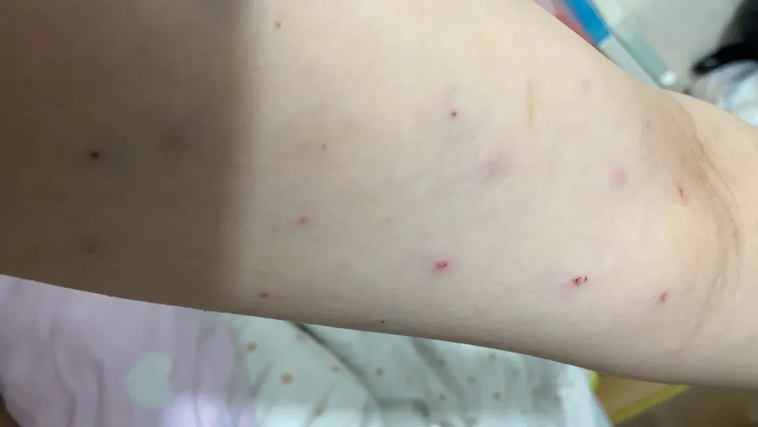 想变瘦却被“千刀万剐”！美女尝试减肥新产品被割成“蜂窝煤”，竟是感染这种细菌