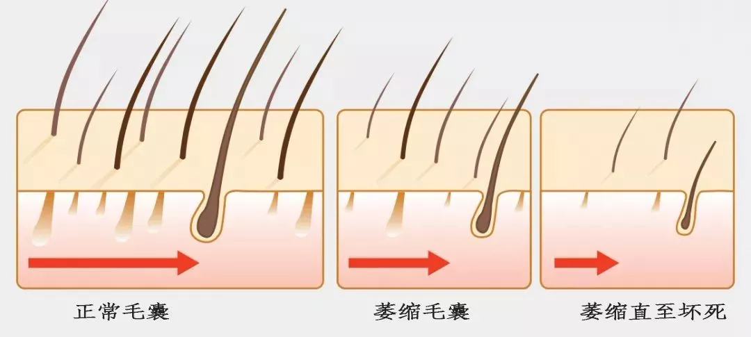 一文读懂M型脱发该怎么治疗
