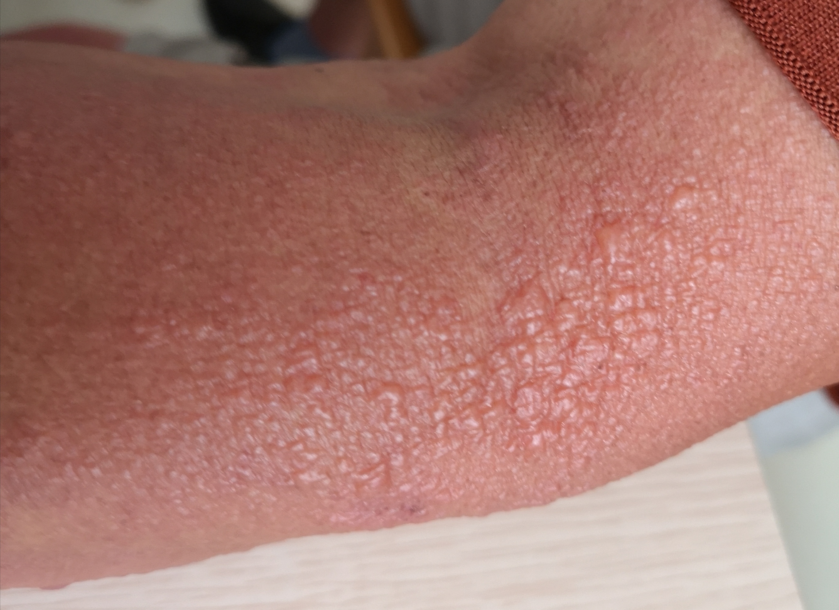 以上两种情况我们都可以称之为"假阴性",在《没天理,皮试阴性还过敏