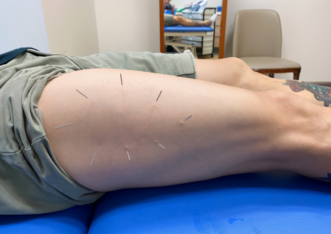 吴尊打篮球受伤，晒腿部针灸照自侃英雄变狗熊，看着害怕又心疼