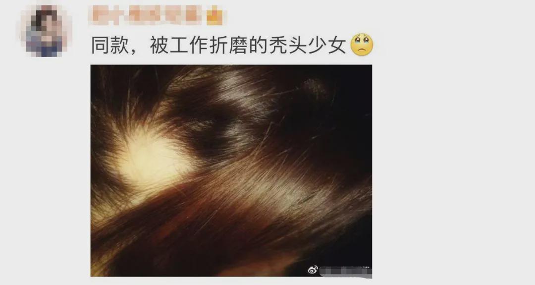 沈夢辰突然斑禿上熱搜！傳說中的"鬼剃頭"盯上年輕人，很多人還蒙在鼓里…