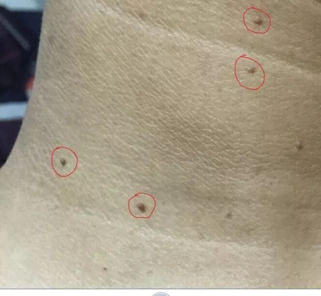 犹如老年斑的扁平疣，严重影响美观，该如何处理？