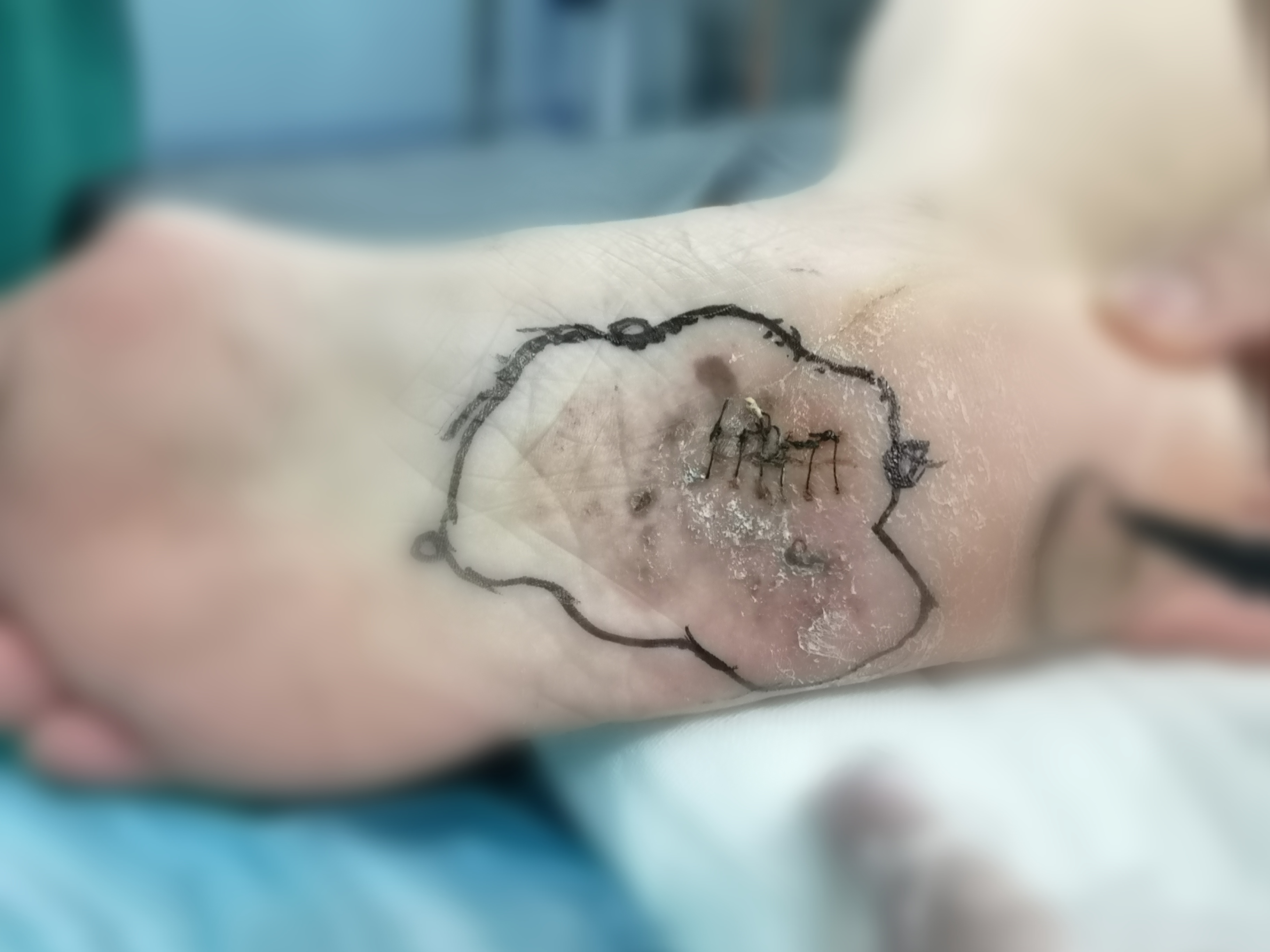 足底颜色不均的黑色斑疹也可以是黑色素瘤_黑色素瘤_症状表现_检查