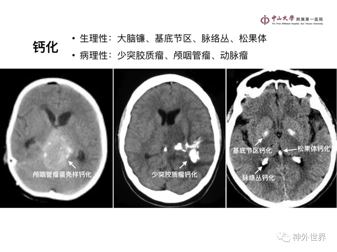 最全影像总结 | 颅内病变 MR、CT 的阅片技巧，太赞了