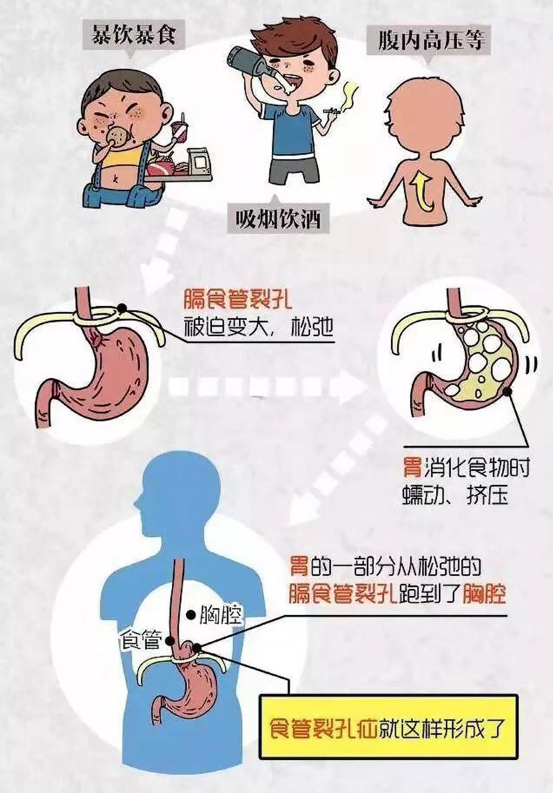 "反酸,烧心,胸闷"久治不愈,警惕食管裂孔疝