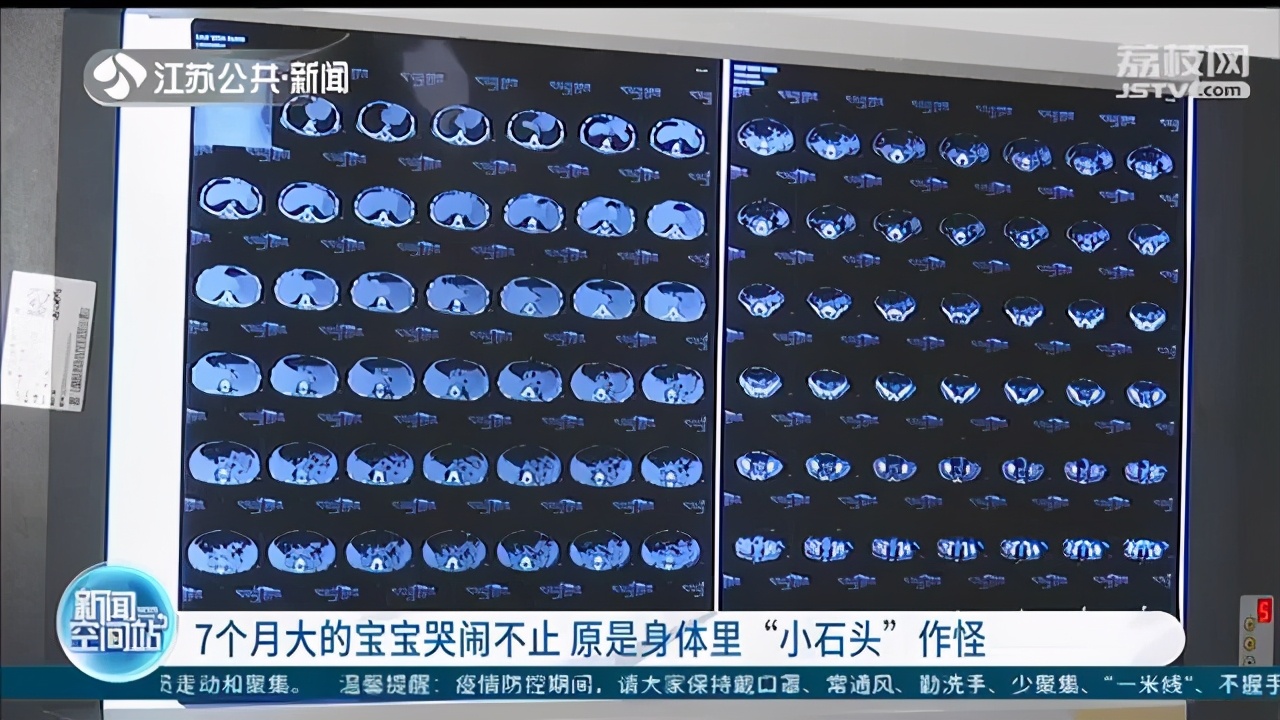 警惕儿童结石！7个月大的宝宝哭闹不止 原是身体里“小石头”作怪