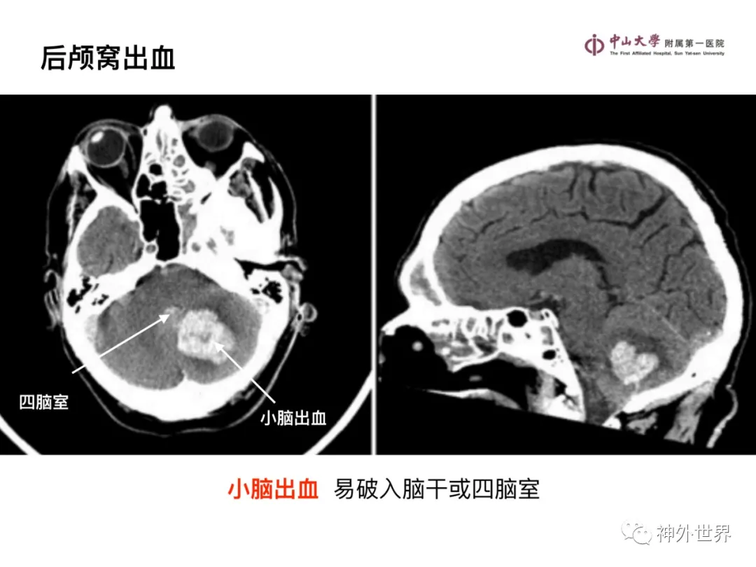 最全影像总结 | 颅内病变 MR、CT 的阅片技巧，太赞了