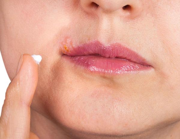 唇炎或是3个因素导致的，四个方法治疗唇炎好的快，很多人不知道