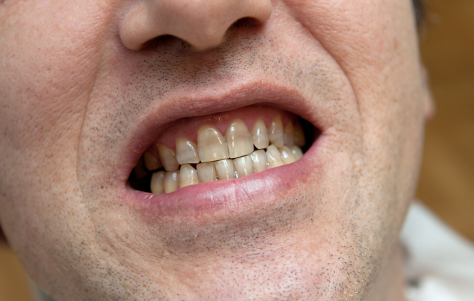 胃裡有幽門螺桿菌，嘴巴通常會發出3個信號，醫生：趁早檢查一下