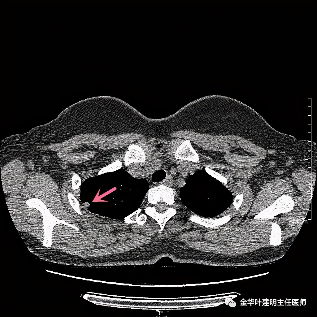 随访明显增大的实性<!--HAODF:8:jiejiebing-->肺结节<!--HAODF:/8:jiejiebing-->肯定是癌吗？要不要手术？