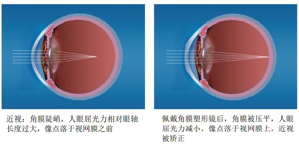 眼科新锐爱博医疗，凭技术开疆拓土，又欲将高端产品销往全球