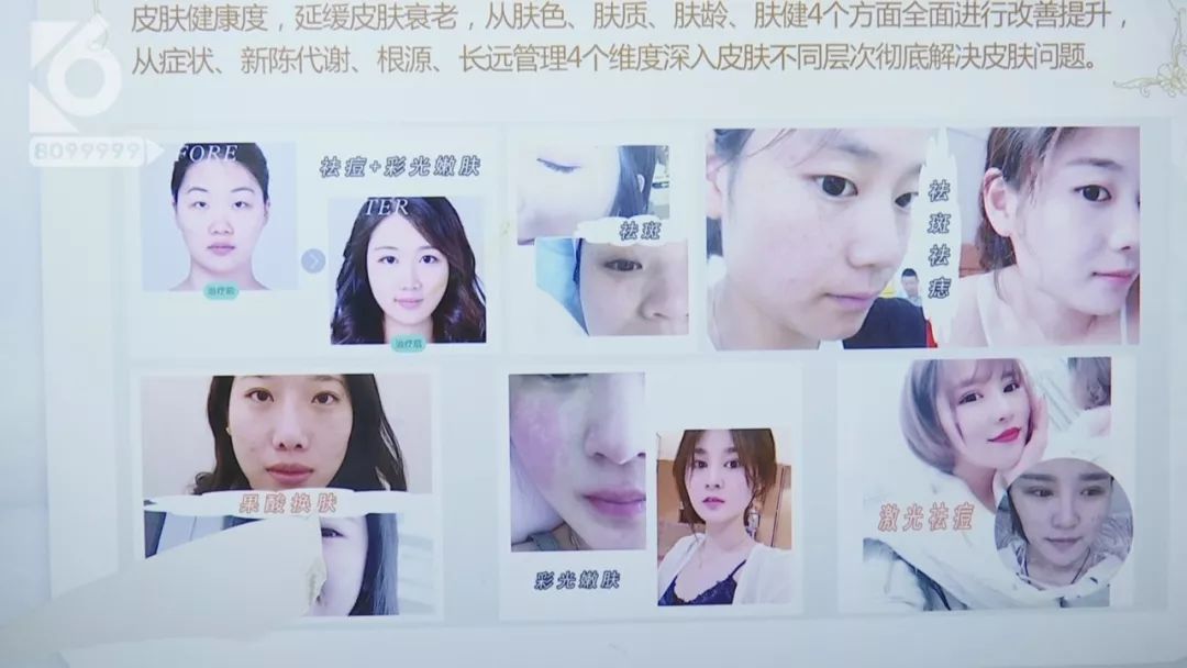 15岁少女执意整形 花11万后整容变毁容