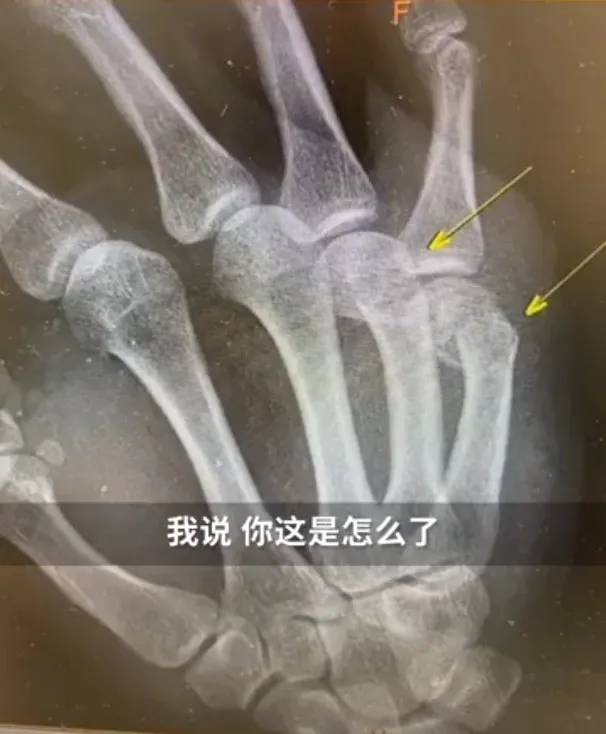 辅导孩子作业生气捶墙致骨折!是孩子太笨还是方法不对?