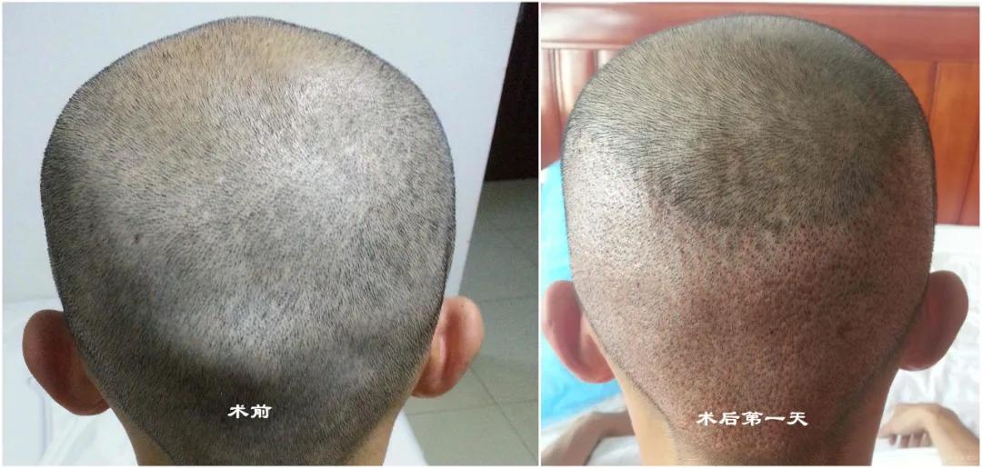 外科医生脱发十年,用了11个月完成自救