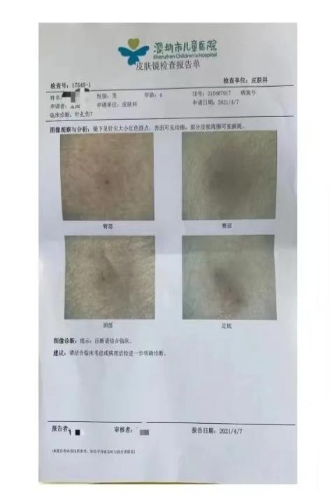 4岁男童被三名幼师扎针数次，针眼遍布全身，家属至今都没立成案
