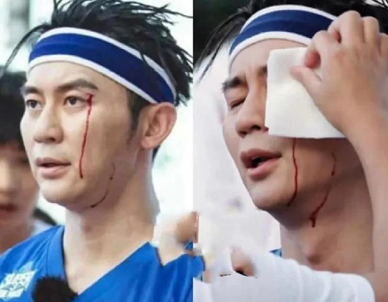 综艺节目有多危险：杨颖手指骨折，宋小宝反复