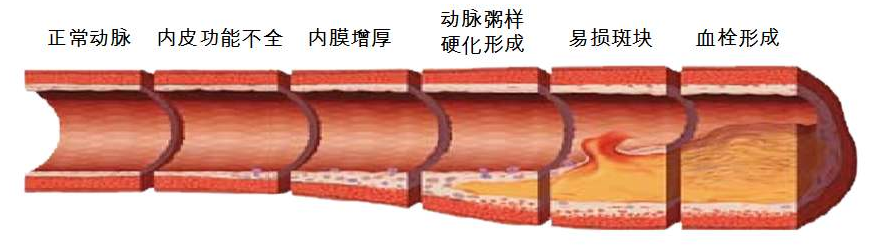 93岁爷爷突发腿脚疼痛，险些截肢！专家强调：警惕这种情况