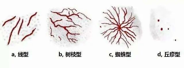 红痘印，黑痘印，这样做就可以去掉