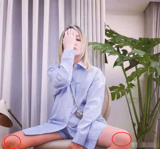 41岁萧亚轩疑添新伤！晒照膝盖大片红肿淤青，刚被狗咬伤还未痊愈