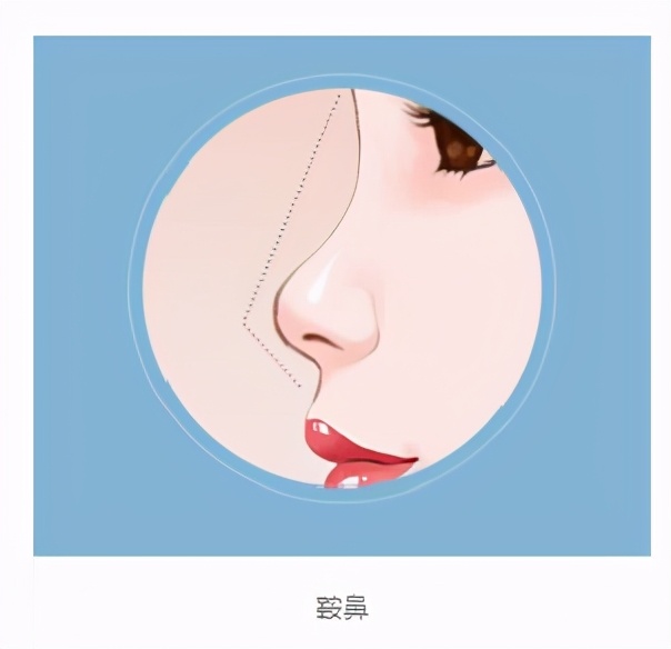 常见的这5种不良鼻型 应该如何改善 鼻部整形
