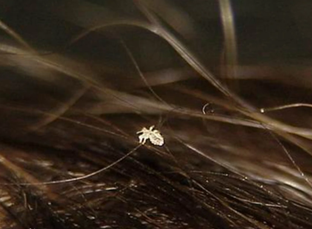 幾十年前農村很多人頭上都有蝨子 為何如今突然沒了 環球科學貓 Mdeditor