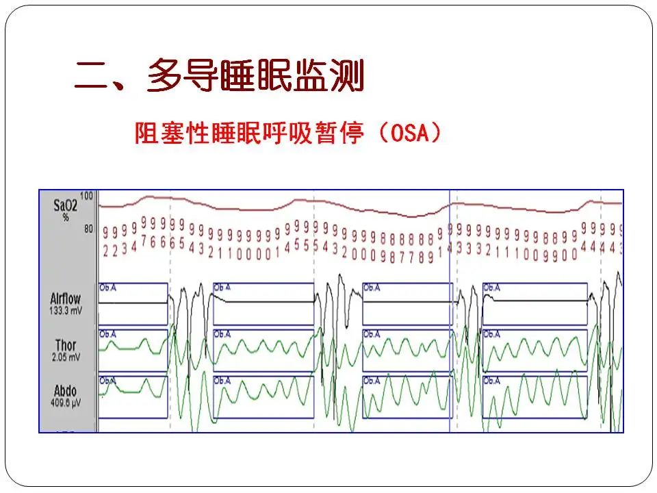 “睡眠呼吸暂停与心血管风险”健康大课堂