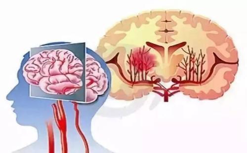 防治心脑血管病，中医药更有优势！中医教你方法，防中风