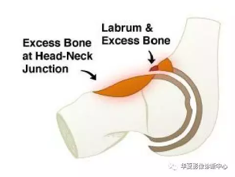 「影像基础」髋关节撞击综合征的发生机制和影像特点