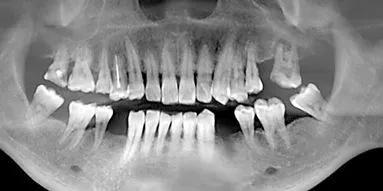 種植牙手術前要做哪些準備