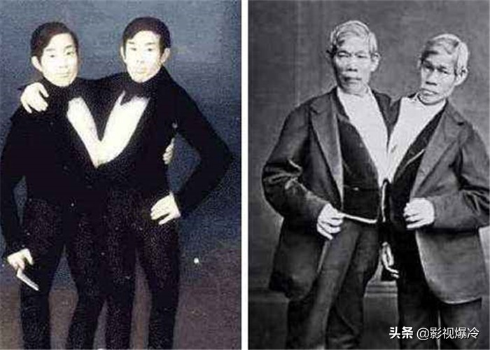 “最奇特的双胞胎”，一个死了另一个会怎样？第3对给出答案