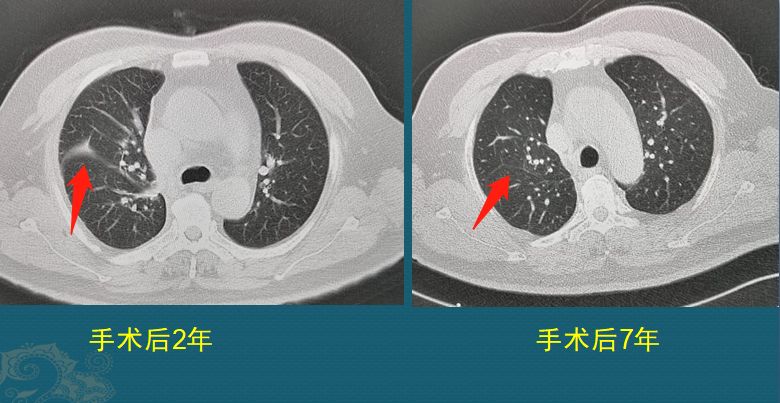 肺癌复发和转移的原因是什么？医生用2个病例，指导正确防癌