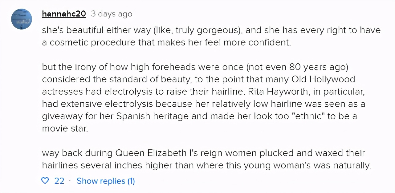 妹纸嫌额头巨大，去做缩额术，将发际线拉低3厘