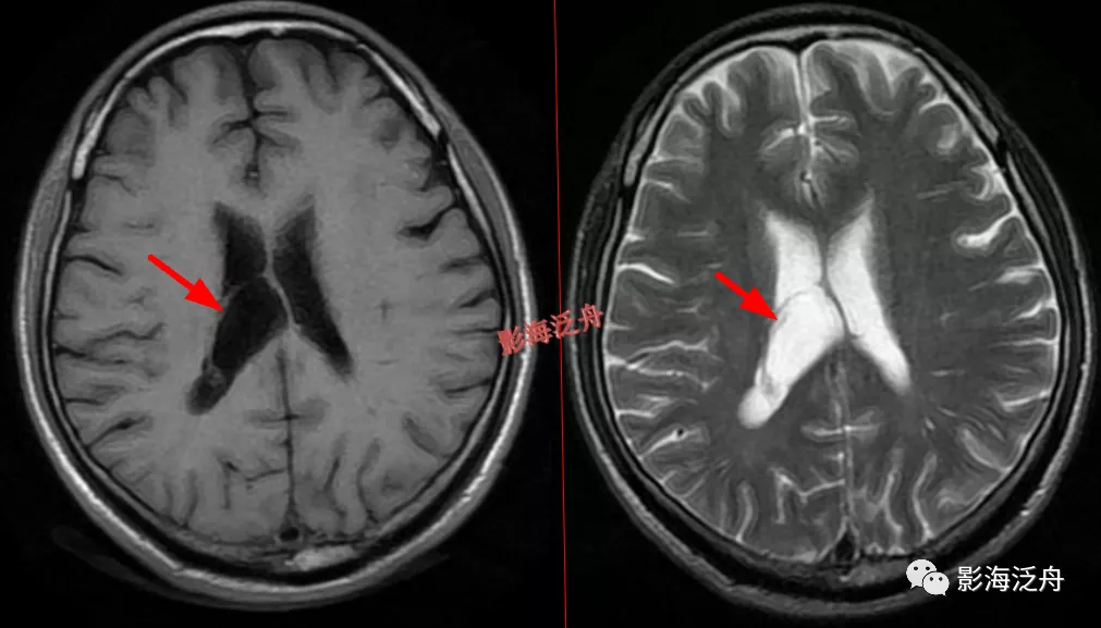 超级干货--颅脑MR中易漏诊点全面总结