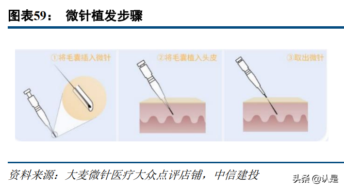 植发行业研究：植发行业前景广阔，龙头连锁抢占先机