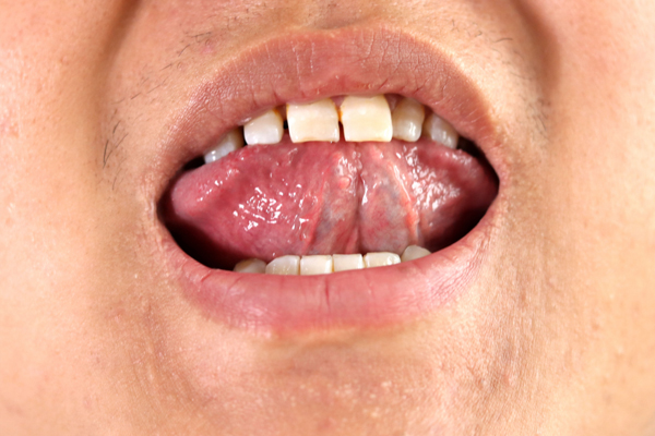 舌下有青筋，是怎么回事？
