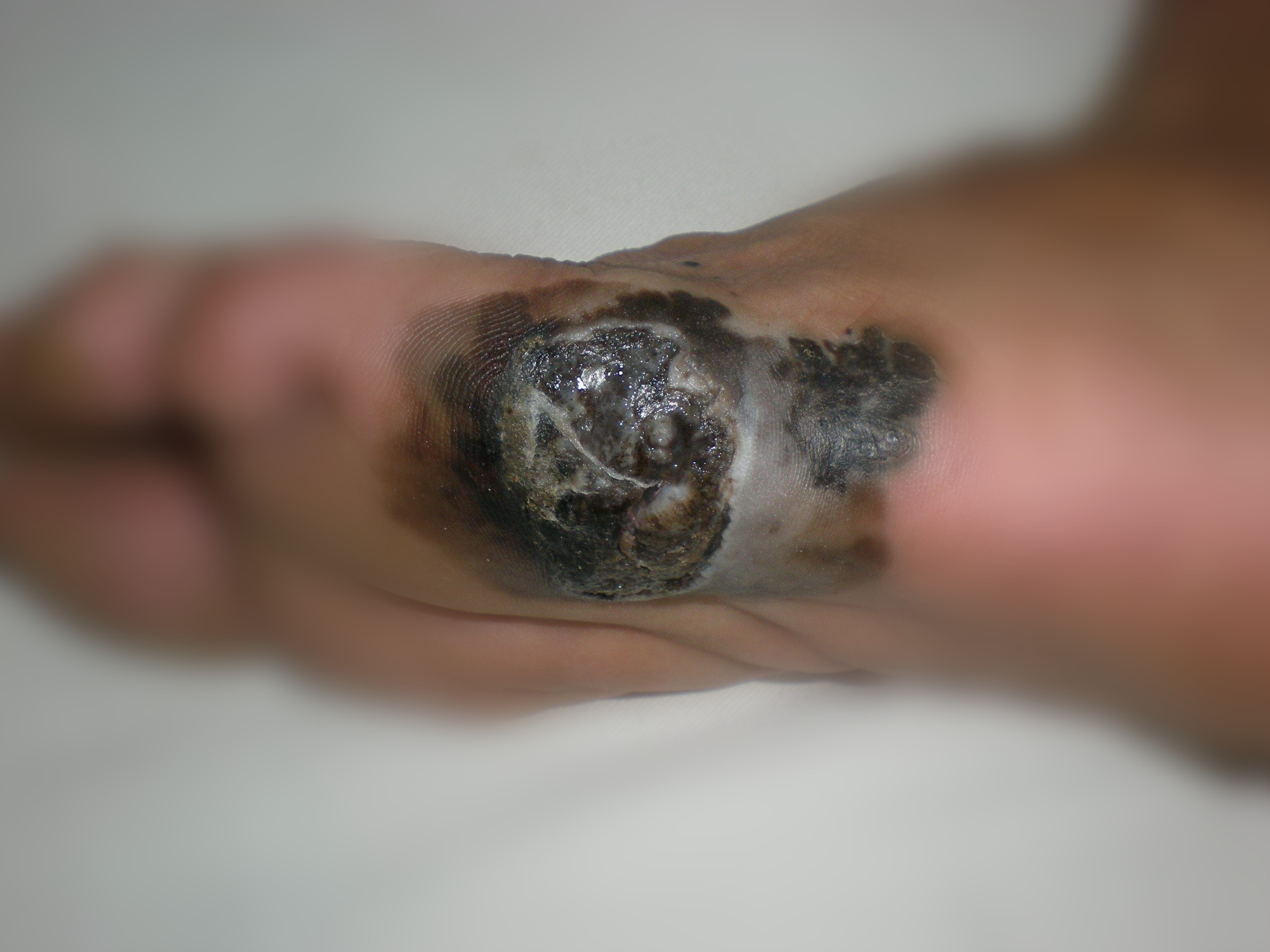 脚底恶性黑色素瘤照片图片