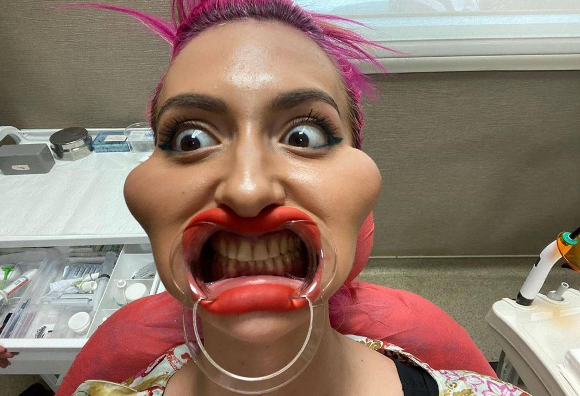 网红模特自称拥有世界最大脸颊4年间多次自行注射药物五官严重变形